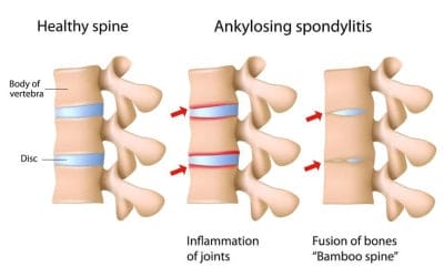 Gangguan Tulang Belakang: Bamboo Spine Atau Ankylosing Spondylitis Beserta 1 Solusinya