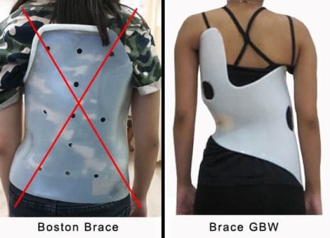 Perbedaan Brace Spesifik Dan Brace Tidak Spesifik Untuk Scoliosis