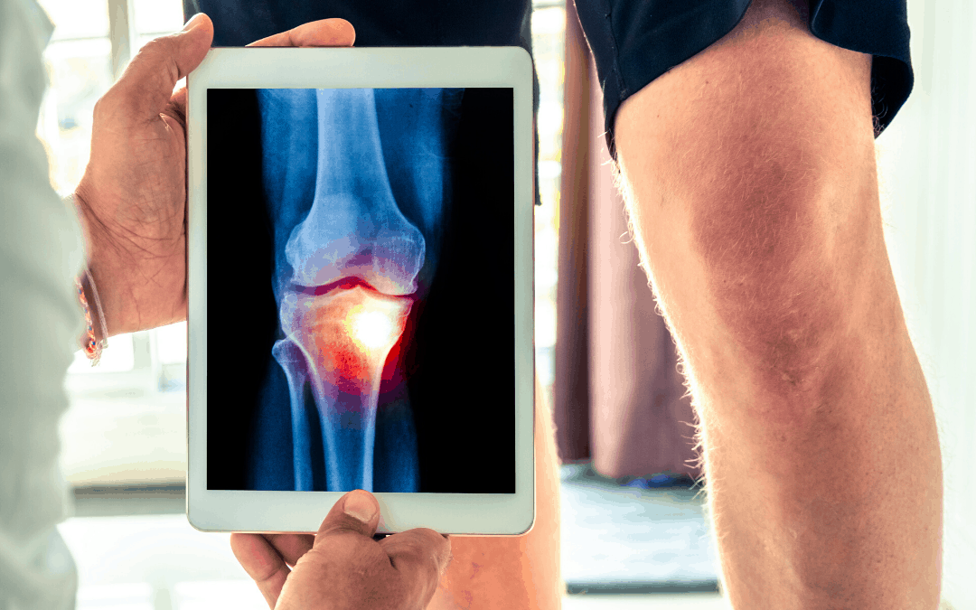 5 Jenis Gangguan Pada Sendi Lutut/ Knee Joint yang Jarang Diketahui!
