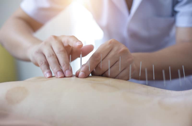 Mengenal Terapi Akupunktur