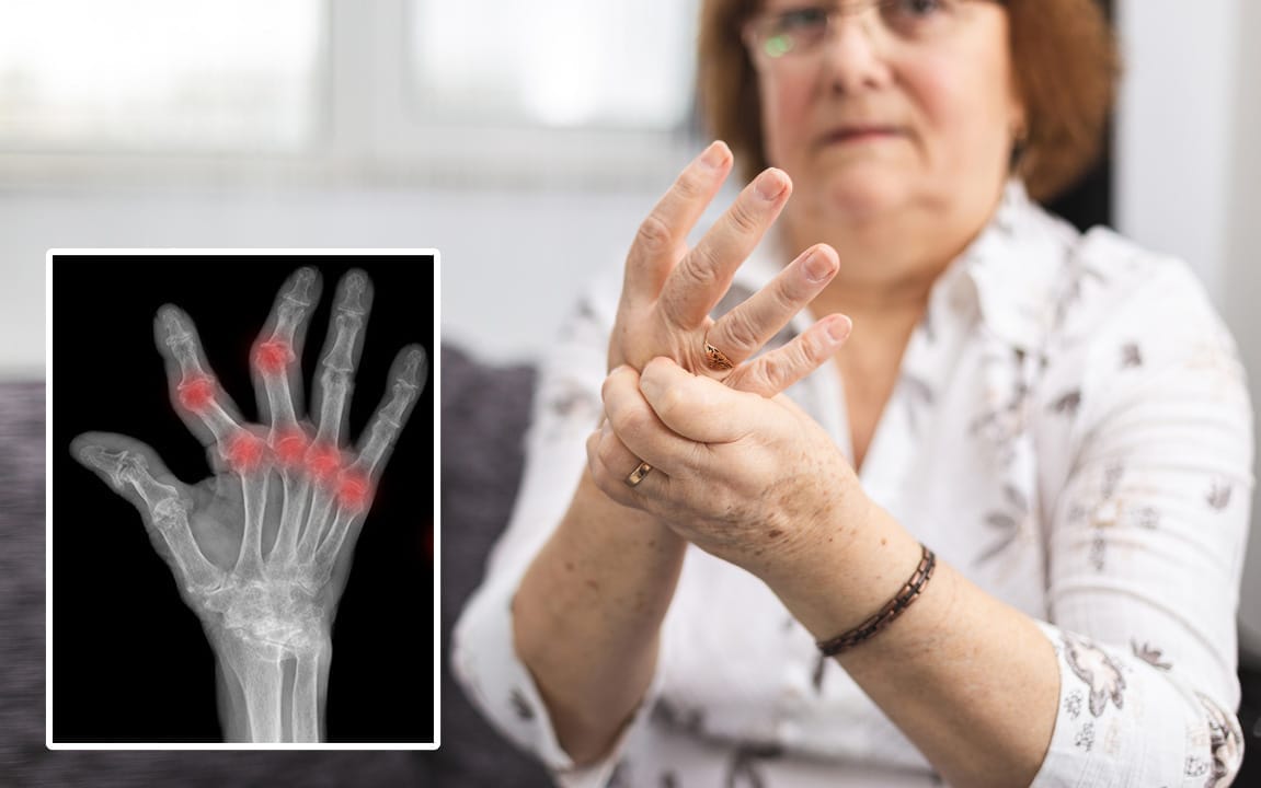 Mengenal Penyakit Rheumatoid Arthritis | Klinik Tulang Belakang