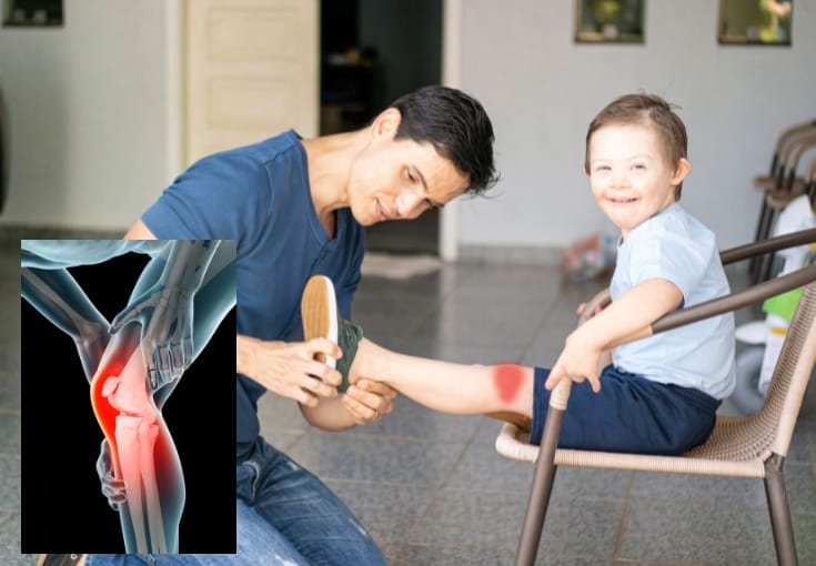Mengenal Joint Hypermobility Syndrome