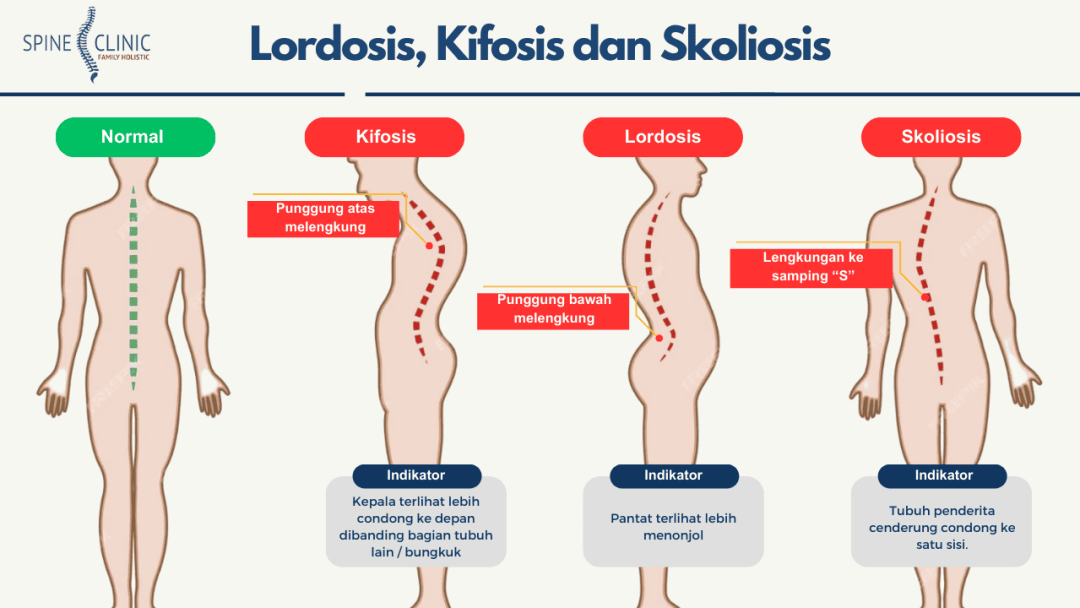 lordosis kifosis dan skoliosis - spine clinic