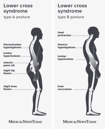 postur tubuh lower crossed syndrome