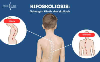 Kifoskoliosis: Kombinasi Kifosis dan Skoliosis, Apakah Lebih Berbahaya?
