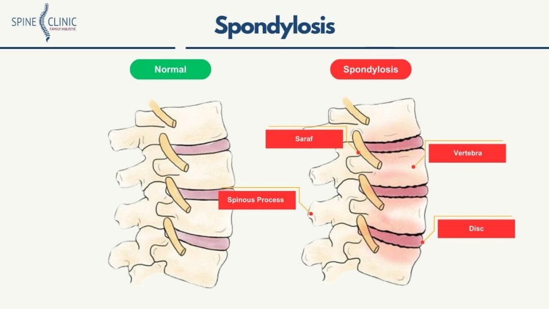 spondilosis atau spondylosis